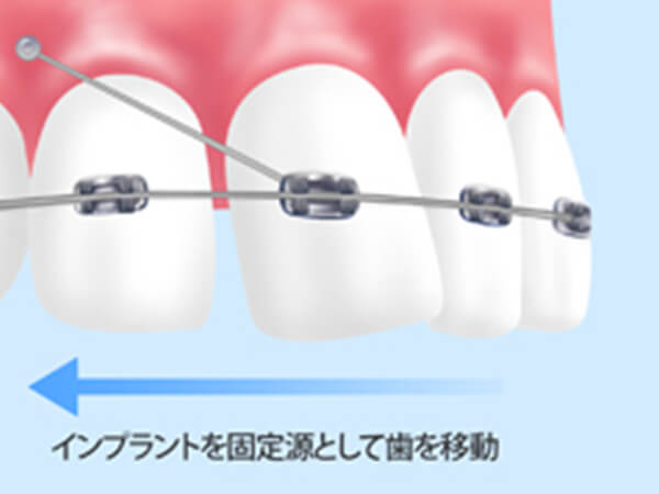 出っ歯の効果的な治療法