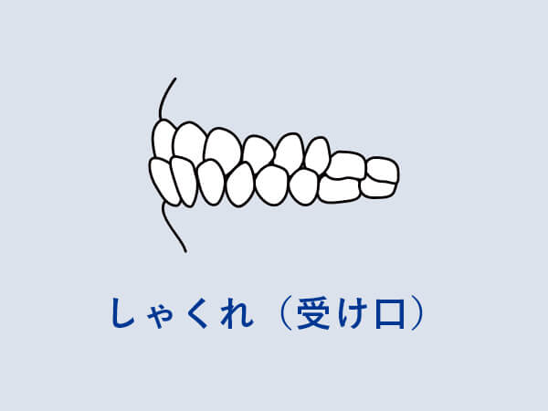 しゃくれ（受け口）の場合は早めの治療を