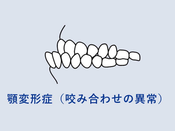 咬み合わせの異常（顎変形症）