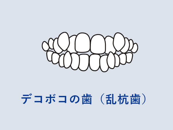 デコボコの歯（乱杭歯）