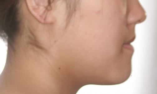 18歳女性　受け口、開咬の症例（外科矯正）