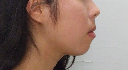 19歳女性「前歯のかみ合わせが気になる」舌のトレーニングとクリアブラケットで治療した症例