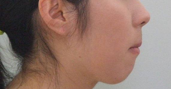 19歳女性　開咬、乱杭歯の症例