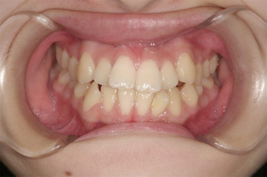 6歳女児　口元が突出し、乱杭歯の症例