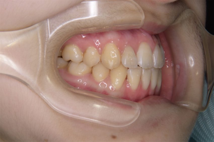 6歳女児　口元が突出し、乱杭歯の症例