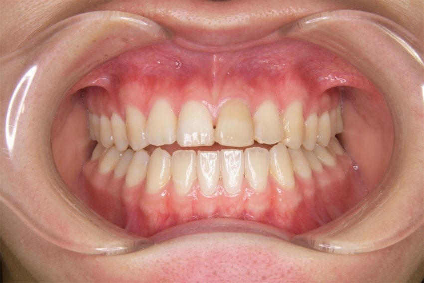 20代女性「受け口を治したい」歯科矯正用アンカースクリューを使って非抜歯で治した症例