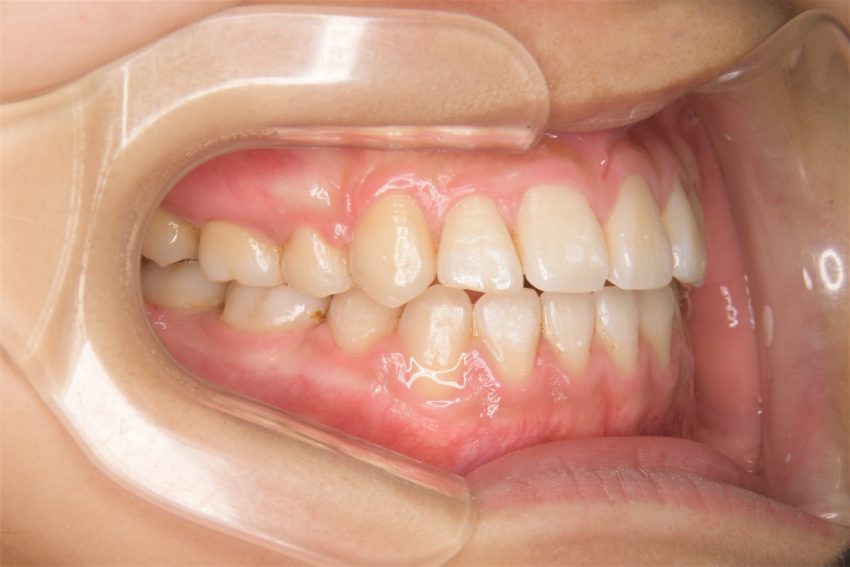 14歳女性　乱杭歯の症例