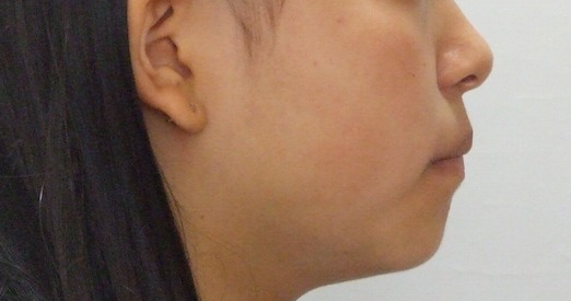 14歳女性　乱杭歯の症例