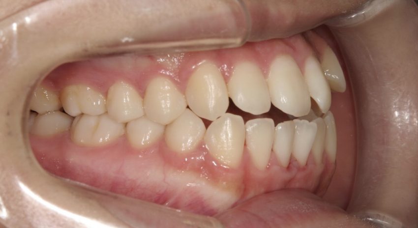 20代女性「犬歯が前に出ている、奥歯が噛み合わない」小臼歯を抜歯せずに矯正した症例