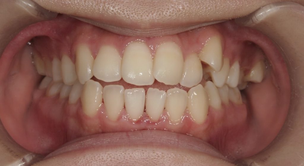 20代女性「犬歯が前に出ている、奥歯が噛み合わない」小臼歯を抜歯せずに矯正した症例