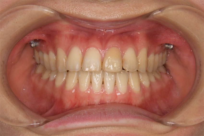 20代女性「受け口を治したい」歯科矯正用アンカースクリューを使って非抜歯で治した症例