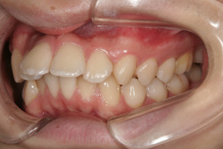 20歳男性「出っ歯とガタガタの歯並びが気になる」抜歯して矯正した症例