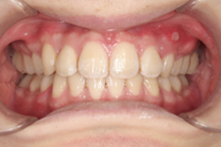 20歳男性「出っ歯とガタガタの歯並びが気になる」抜歯して矯正した症例