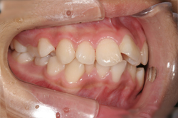 小学6年生女の子「前歯がでこぼこしている」抜歯をして矯正した症例