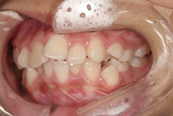 小学6年生女の子「前歯がでこぼこしている」抜歯をして矯正した症例