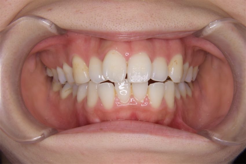 20代女性「口元が出ていて気になる」抜歯と矯正で治療した症例