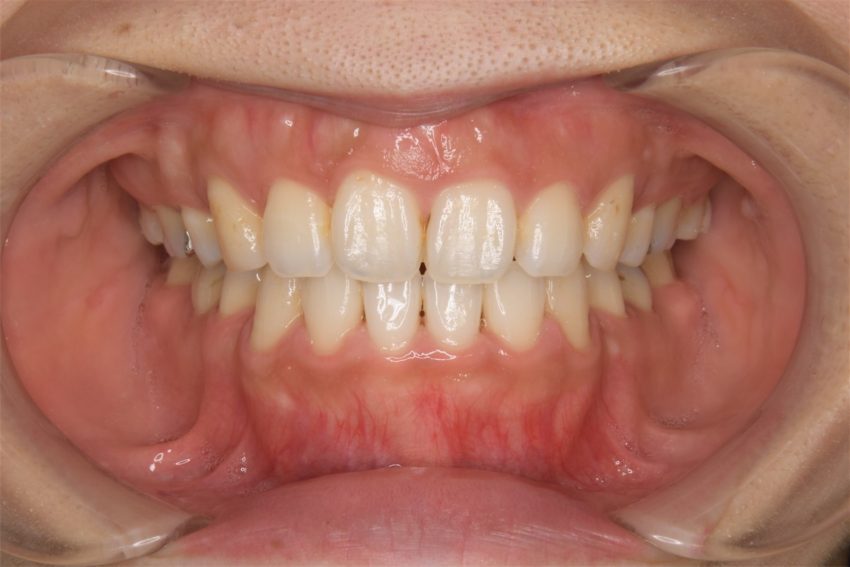20代女性「口元が出ていて気になる」抜歯と矯正で治療した症例