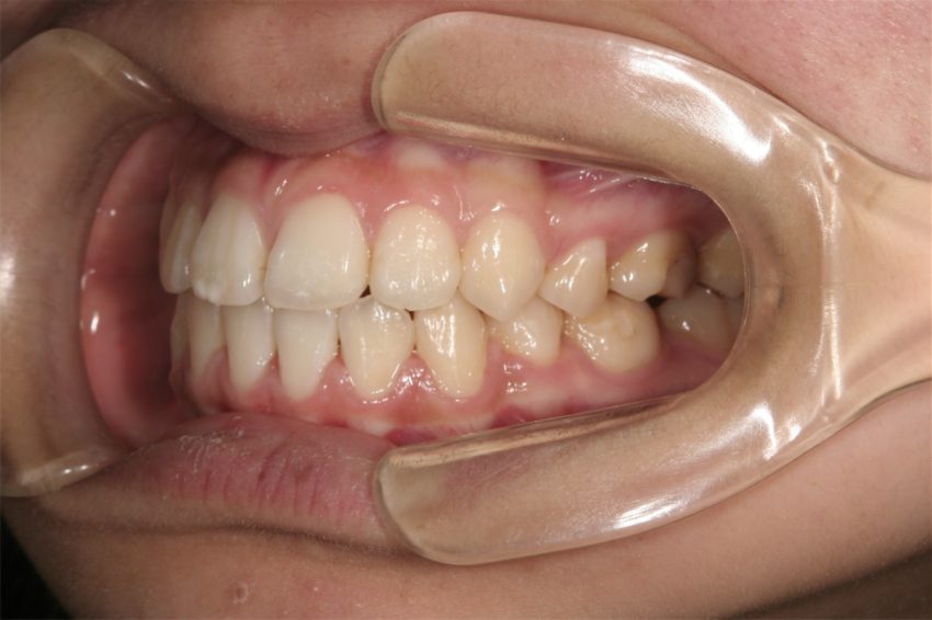 16歳女性　口元が突出し、乱杭歯の症例