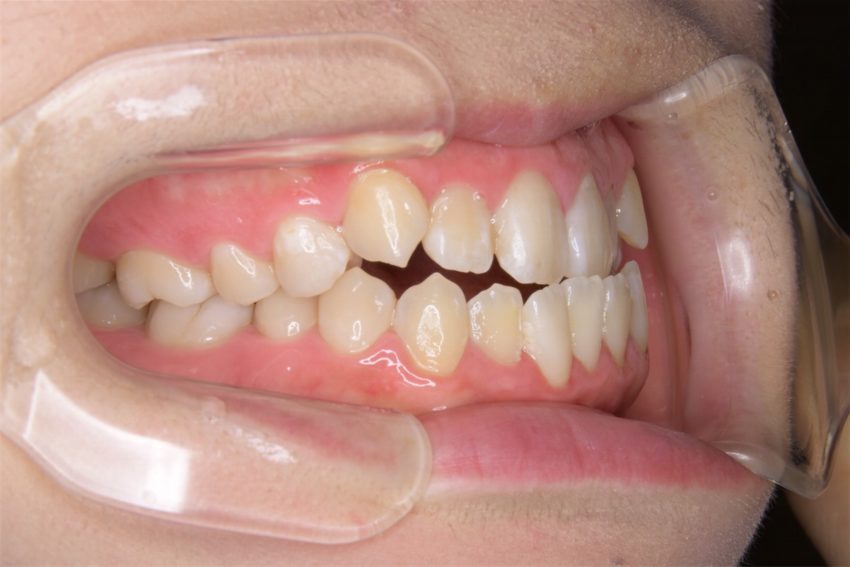 19歳女性「前歯のかみ合わせが気になる」舌のトレーニングとクリアブラケットで治療した症例