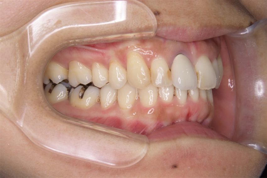 30代女性「歯並びが悪く楽器の演奏ができない」マウスピース型矯正装置(インビザライン)の症例