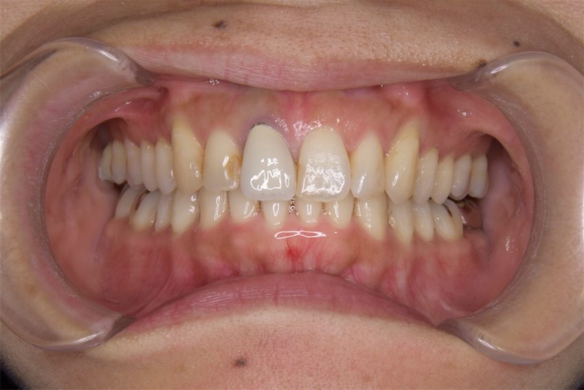 30代女性「歯並びが悪く楽器の演奏ができない」マウスピース型矯正装置(インビザライン)の症例