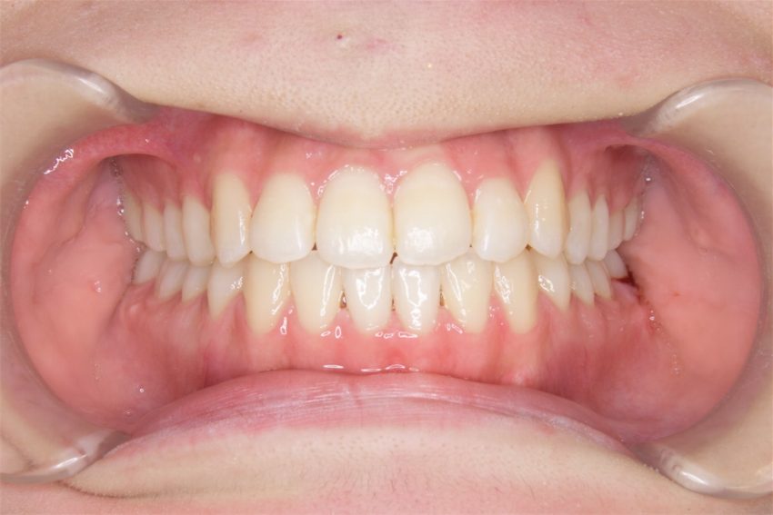 ２０歳女性　乱杭歯の症例