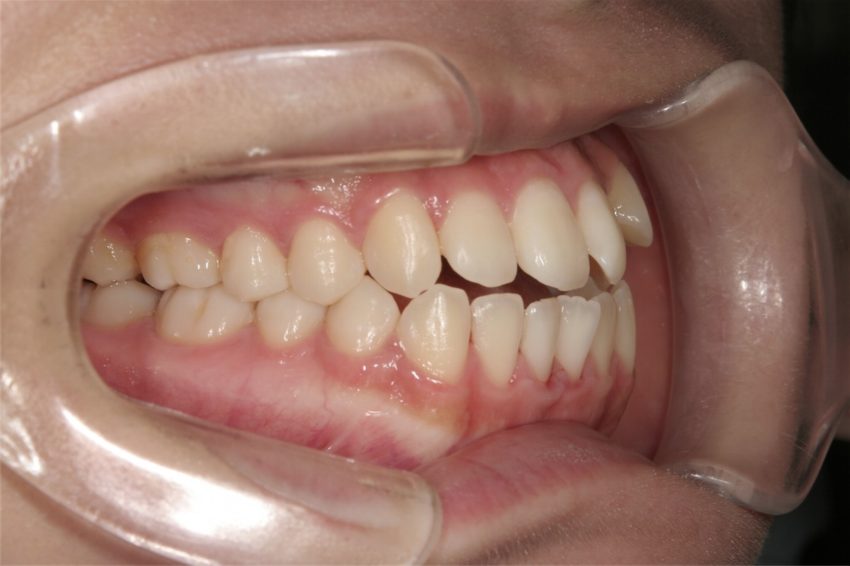 ２０歳女性　乱杭歯の症例