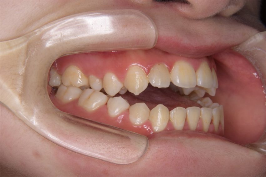 20代女性「上下の前歯が噛み合っていない」歯科矯正用アンカースクリューを使って外科手術せず治した症例