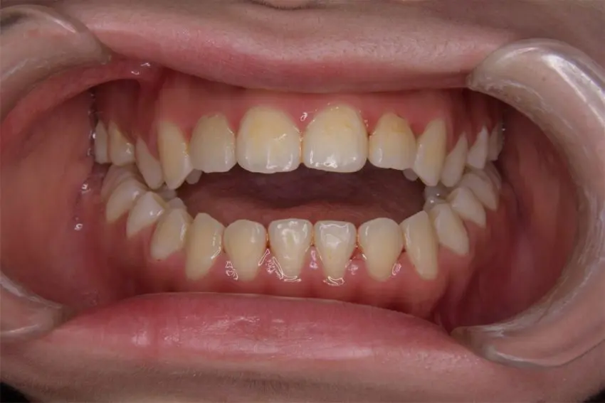 20代女性「上下の前歯が噛み合っていない」歯科矯正用アンカースクリューを