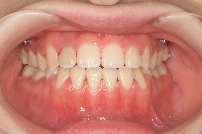 20代女性「上下の前歯が噛み合っていない」歯科矯正用アンカースクリューを使って外科手術せず治した症例