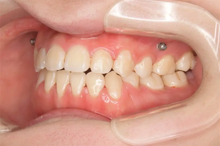 20代女性「上下の前歯が噛み合っていない」歯科矯正用アンカースクリューを