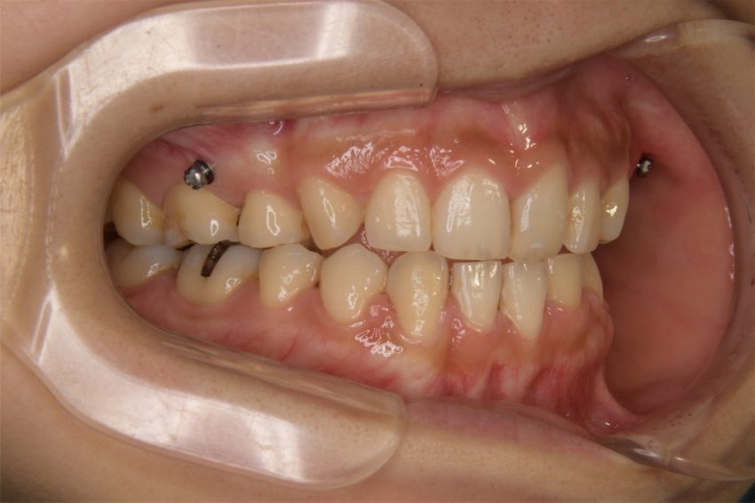 20代女性「前歯のデコボコが気になる」ハーフリンガルで矯正した症例
