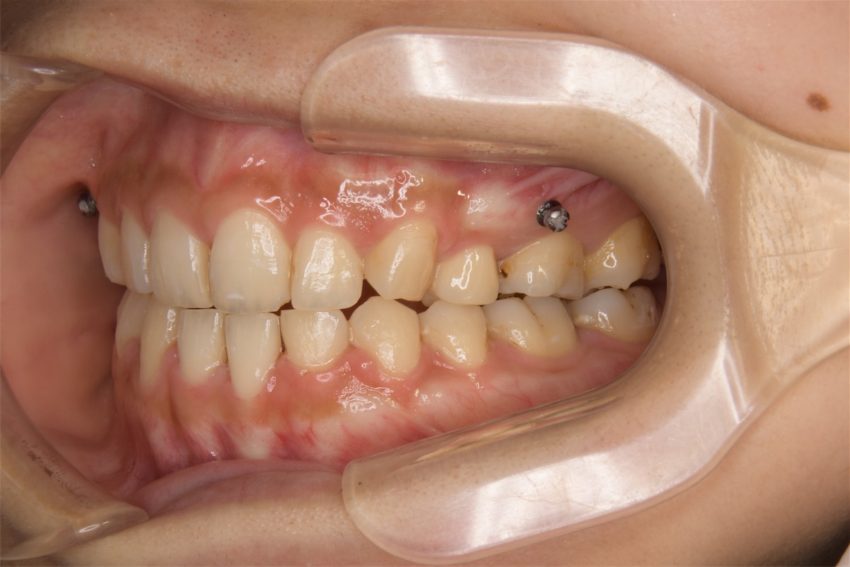20代女性「前歯のデコボコが気になる」ハーフリンガルで矯正した症例