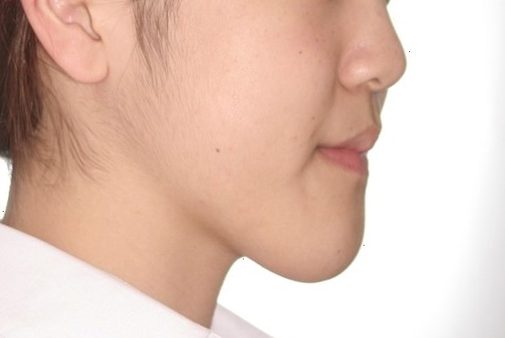 17歳女性(高校2年生)「顎変形症下顎前突と開咬」を外科手術を併用して治療した症例