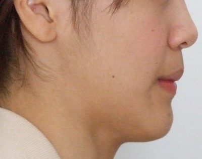 17歳女性(高校2年生)「顎変形症下顎前突と開咬」を外科手術を併用して治療した症例