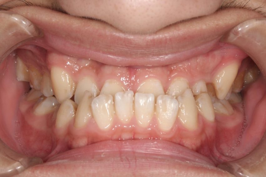20代男性「前歯の噛み合わせを治したい」不正咬合をワイヤー矯正で治療した 症例