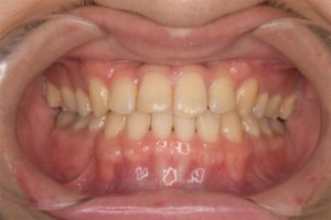 20代男性「前歯の噛み合わせを治したい」不正咬合をワイヤー矯正で治療した 症例