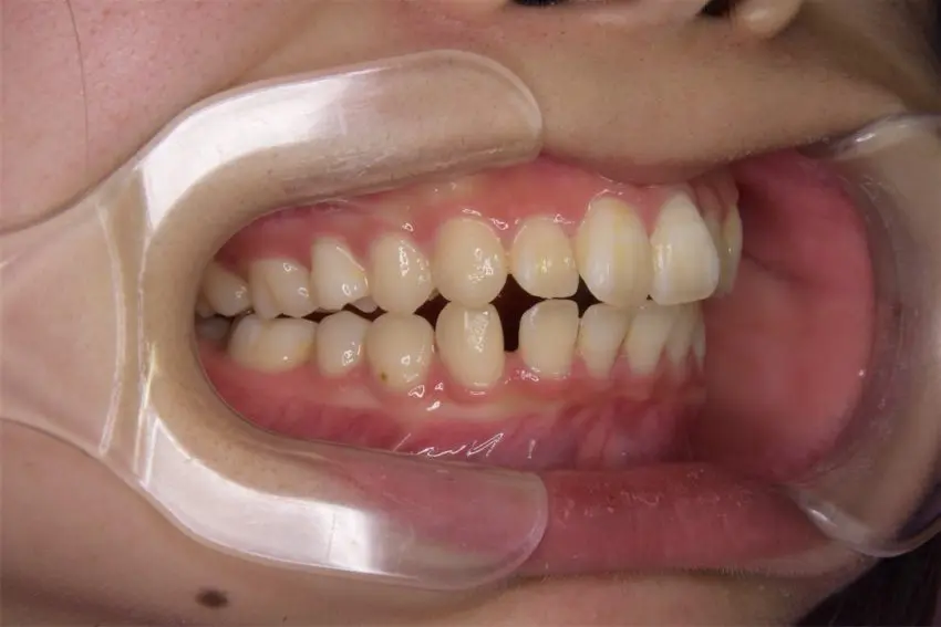 10代女性「下の 12歳臼歯が生えてこない」ワイヤー矯正で治療した症例