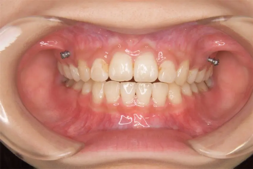 10代女性「下の 12歳臼歯が生えてこない」ワイヤー矯正で治療した症例