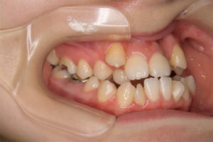 矯正治療と歯茎さがり（歯肉退縮）について