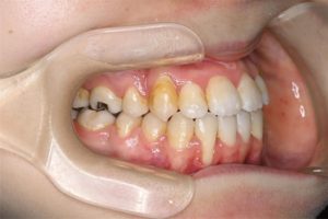 矯正治療と歯茎さがり（歯肉退縮）について｜下顎の歯根が手術のあとに露出し歯肉退縮が認められる｜高橋矯正歯科医院