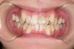 矯正治療と歯茎さがり（歯肉退縮）について｜矯正治療前、下顎の犬歯の歯茎がさがっている写真｜高橋矯正歯科医院