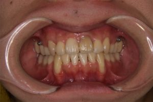 矯正治療と歯茎さがり（歯肉退縮）について｜矯正治療直後、犬歯の歯肉が少し退縮している写真｜高橋矯正歯科医院