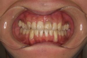 矯正治療と歯茎さがり（歯肉退縮）について｜矯正治療2年後、犬歯の歯根表面がやや削れている写真｜高橋矯正歯科医院