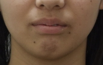 10代女子高校生「重度の上顎前突（出っ歯）」をマルチブラケットと歯科矯正用アンカースクリューで矯正治療した症例