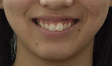 10代女子高校生「重度の上顎前突（出っ歯）」をマルチブラケットと歯科矯正用アンカースクリューで矯正治療した症例