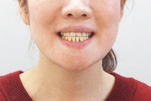 20代女性・外科手術を併用する矯正治療で受け口（しゃくれ）・顎関節症を改善させた症例