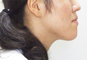 外科手術を併用する矯正治療で受け口(しゃくれ)・顎関節症を改善させた症例|神奈川県秦野市の歯医者「高橋矯正歯科医院」