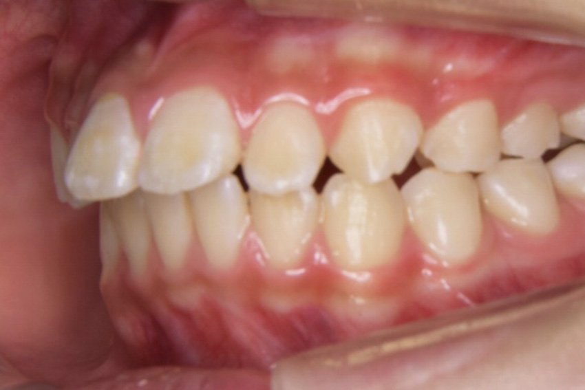 小学校中学年・男子「出っ歯（上顎前突）」を永久歯が生え揃った後に矯正治療と抜歯を行い改善した症例
