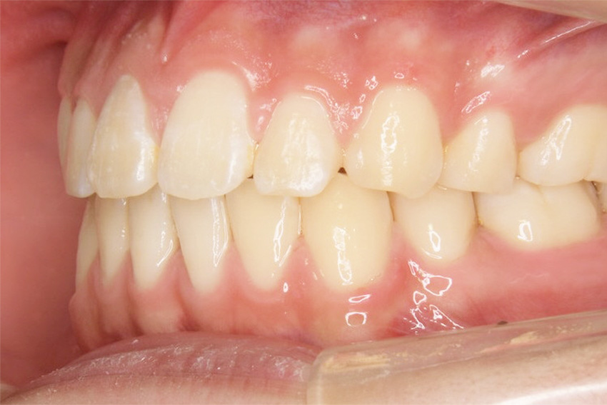 小学校中学年・男子「出っ歯（上顎前突）」を永久歯が生え揃った後に矯正治療と抜歯を行い改善した症例